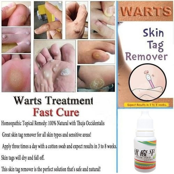 Skin Tag Mole Wart Remover