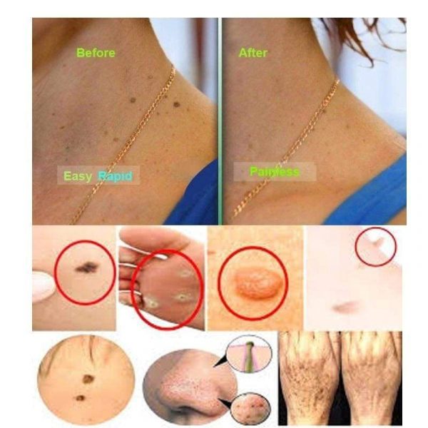 Skin Tag Mole Wart Remover