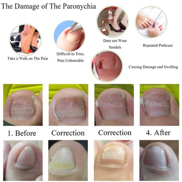 Ingrown Toe Nail Correction Sticker