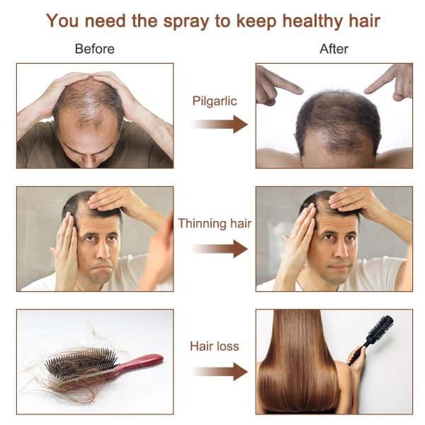 Activehair Hair Growth Spray , Ginger Hair Spray For Hair Growth