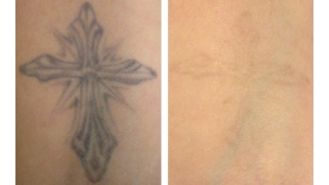 TatOFF 4 Weeks Tattoo Removal Cream photo review